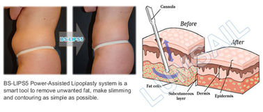 기계 지방 흡입 수술 lipolysis 공동현상 기계를 형성하는 몸