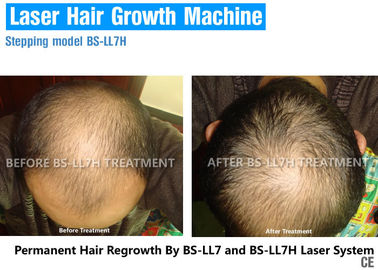 머리 성장을 위한 저수준 레이저 치료